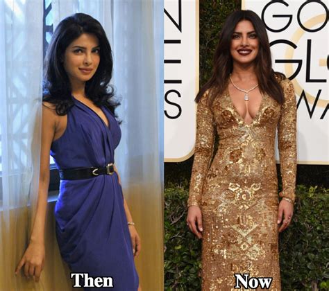 Priyanka Chopra Plastic Surgery Before And After Photos Latest