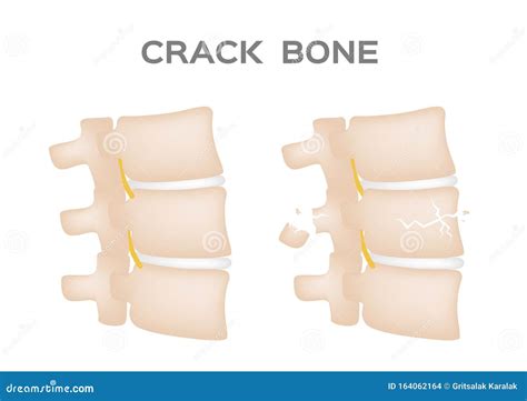 Spine Broken Neck Showing Cervical Vertebra Fracture Stock Image