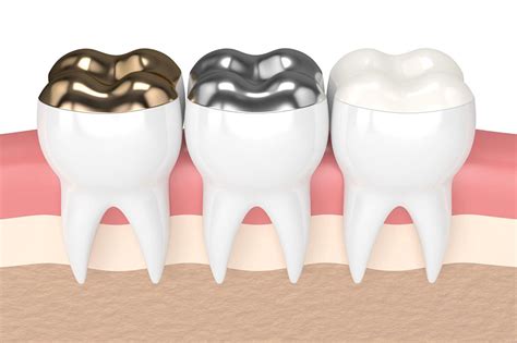 Pros and Cons of Composite Fillings - Smile Plus Dental - Dr Falguni ...