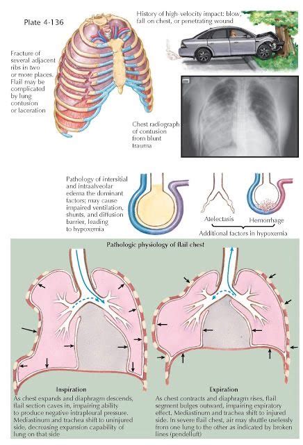 Flail Chest Diagram