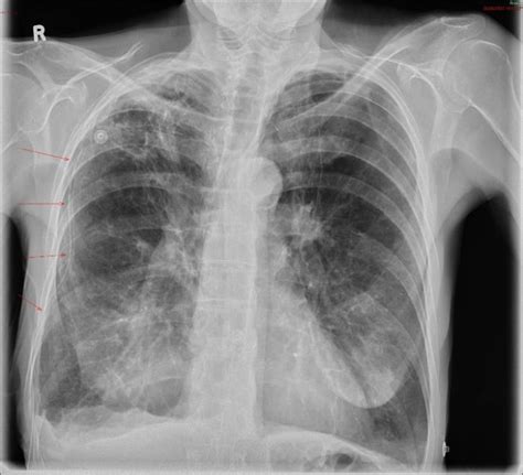 A PA Chest X Ray With Intercostal Drain Projected Over The Lateral