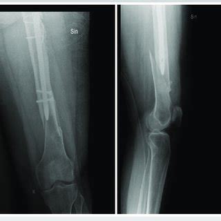 Postoperative Radiographs Of The Left Femur Periprosthetic Fracture