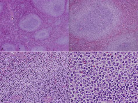 Figure From Splenic Marginal Zone Lymphoma Semantic Scholar