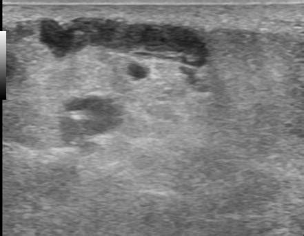 Superficial Thrombophlebitis Radiology Case Radiopaedia Org