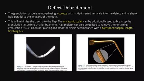 Minimally Invasive Periodontal Surgery Ppt