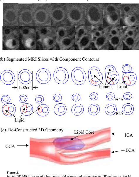 Figure 1 From Patient Specific Artery Shrinkage And 3D Zero Stress