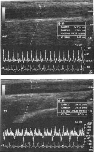 Exercise Induced Brachial Artery Vasodilation Role Of Free Radicals