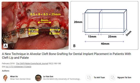 New Technique In Alveolar Cleft Bone Grafting For Implant