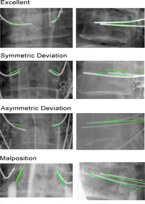 Figure 2 From Assessing The Intraoperative Accuracy Of Pedicle Screw