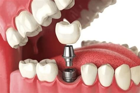 Top 10 Dental Implant Services At Platinum Dental Care Platinum