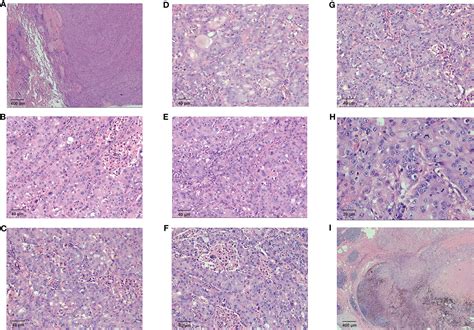 Frontiers A Case Report Of Pulmonary Hepatoid Adenocarcinoma