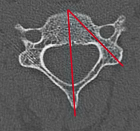 Morphometric Analysis of Subaxial Cervical Spine Pedicles in a Middle ...