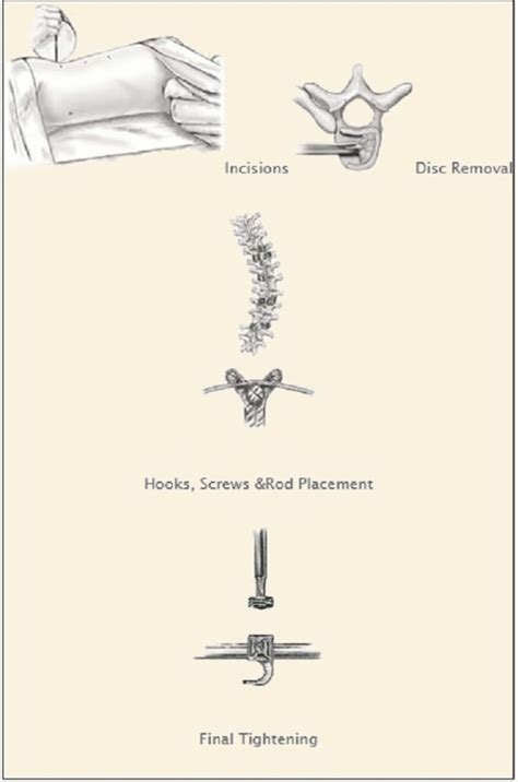 Anterior Posterior Approach Spine Care Houston Tx Modern Spine