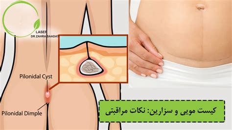 What Is A Pilonidal Cyst Dr Zahra Saadati Laser Surgery