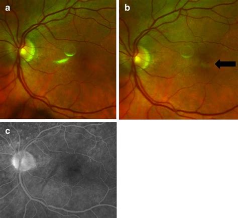 Fundus Photography And Fluorescein Angiography Fa Of The Left Eye A