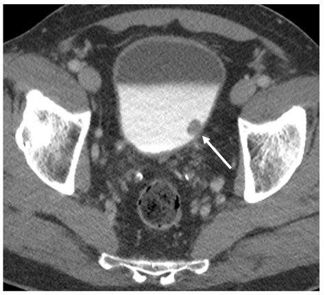 Diagnostics Free Full Text The Role Of Imaging In Bladder Cancer