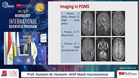 Multiple Sclerosis Chapter Prof Hussein Mohamed Hussein Lecture Mash