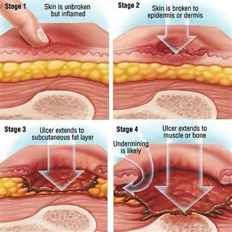 Wound care guideline (part 3) - Pressure wound dressing