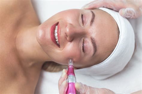 Microneedling 15 häufig gestellte Fragen und Antworten DGN Aesthetik