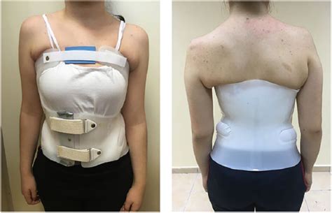 Thoracolumbosacral Orthosis