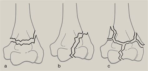 The Armdoc Supracondylar And Intercondylar Humeral Fractures