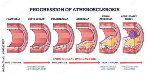 Progression Of Atherosclerosis And Thrombosis Formation Outline Diagram