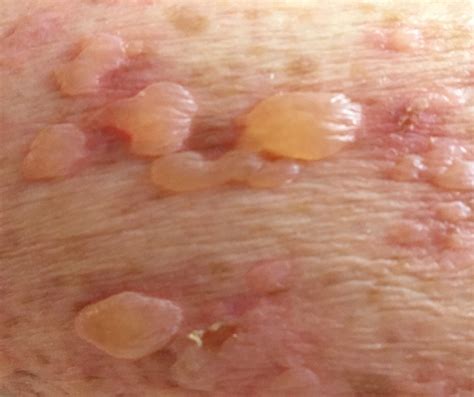 Bullous Pemphigoid Pictures