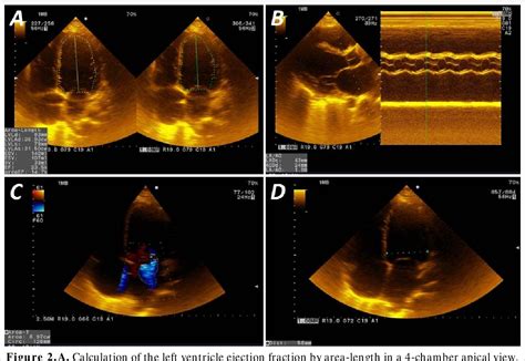 Figure 2 From Idiopathic Dilated Cardiomyopathy In An Asymptomatic