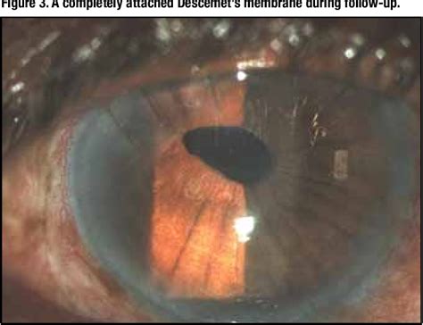 Figure 2 From Surgical Repair Of Descemet’s Membrane Detachment Following Phacoemulsification By