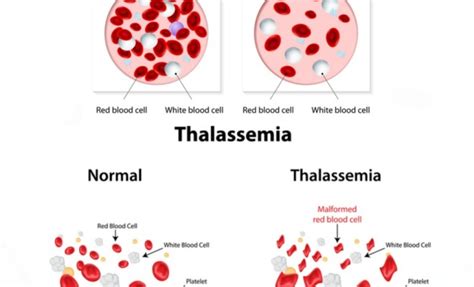 Living With Thalassemia