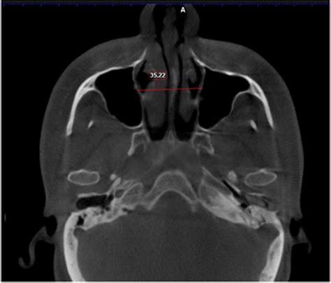 Figure 5 Showing The Intermaxillary Distance In Axial Cut The Role