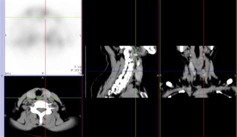 M Tc Mibi Spect Ct Image Of Parathyroid Gland Hyperplastic Nodules In