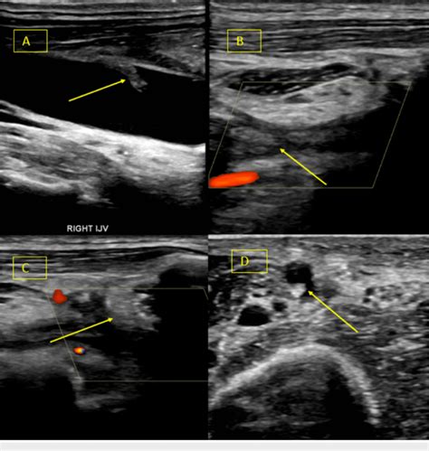 Doppler ultrasound right upper extremity demonstrating (A) chronic ...