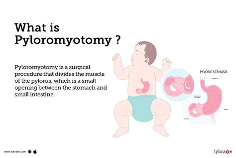 Pyloromyotomy Causes Symptoms Treatment And Cost