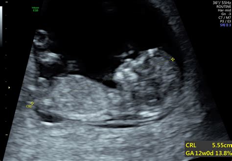 Nuchal Translucency Image Radiopaedia Org