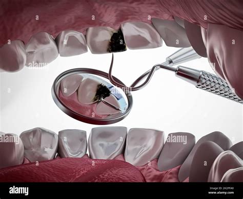 Decayed tooth diagnosis and treatment. 3D illustration Stock Photo - Alamy