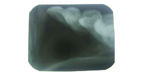 Intra Oral Periapical Radiograph Revealed A Well Defined Radiolucency