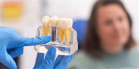 How To Care For Your Dental Implants For Longevity