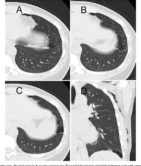 Figure 2 From Congenital Cystic Adenomatoid Malformation In Adults Report Of A Case Presenting