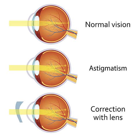 Royalty Free Astigmatism Clip Art, Vector Images & Illustrations - iStock