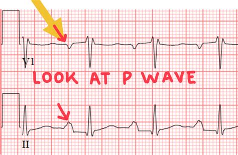 Ekg Hypertrophy And Enlargement Flashcards Quizlet