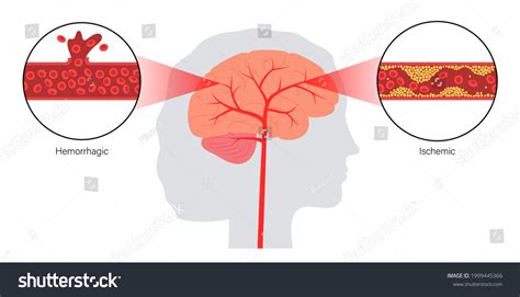 Brain Stroke Hemorrhagic Ischemic Problem Arteriosclerosis Stock Vector