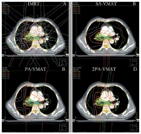 Isodose Curves Of Pa Vmat And Imrt Plans In Central Lung Cancer In