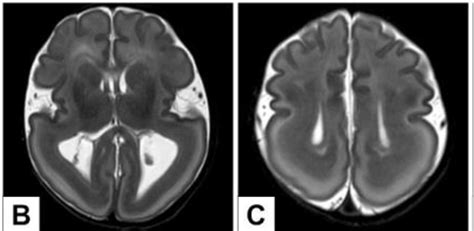 Posterior Lissencephaly Associated With Subcortical Band Heterotopia