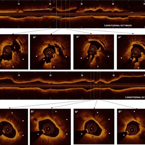 Representative Optical Coherence Tomography OCT Images To Define