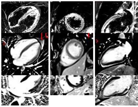 Cmr During Myocarditis Episode Tirm Sequence With Myocardial Edema In