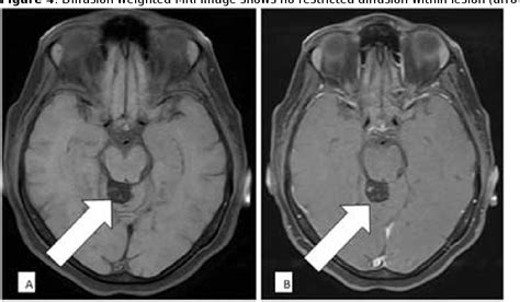 Quadrigeminal Plate Lipoma