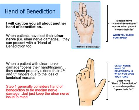 Hand Of Benediction Vs The Claw Hand The Ulnar Paradox Atelier Yuwa