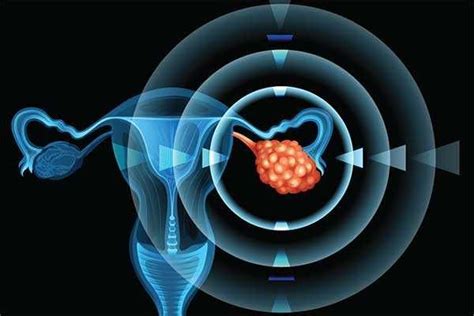 Kanker Ovarium Epitel Penyebab Gejala Diagnosis