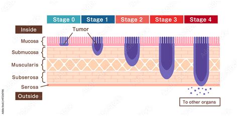 Stages of stomach cancer (gastric cancer) . Vector illustration Stock ...